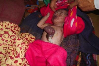 بالصور.. طفل هندي يولد بقلب بارز