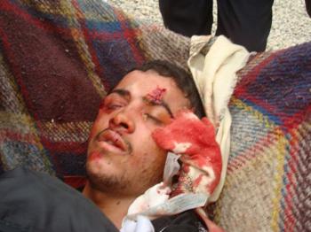 اليمن:منظمة الكرامة تراسل الأمم المتحدة بشأن عشرات القتلى ومئات الجرحى في الاحتجاجات الجارية