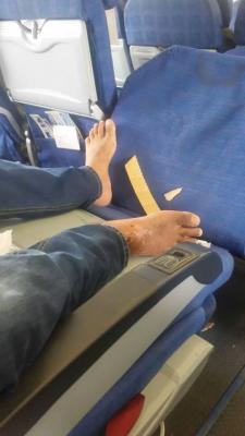 جماعة الحوثي تحتجز طائرة بمطار صنعاء على متنها « 15»من جرحى المقاومة الجنوبية