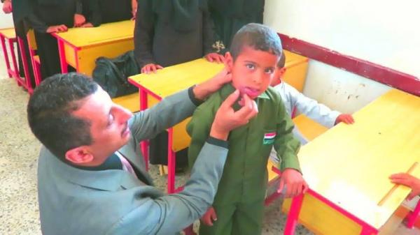 اليمن : الحرب تخلق داءً فتاكًا يأكل أجساد اليمنيين (صور)