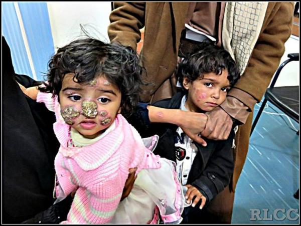 اليمن : الحرب تخلق داءً فتاكًا يأكل أجساد اليمنيين (صور)
